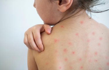 Casos de varicela podrían confundirse con viruela del mono, según dermatóloga
